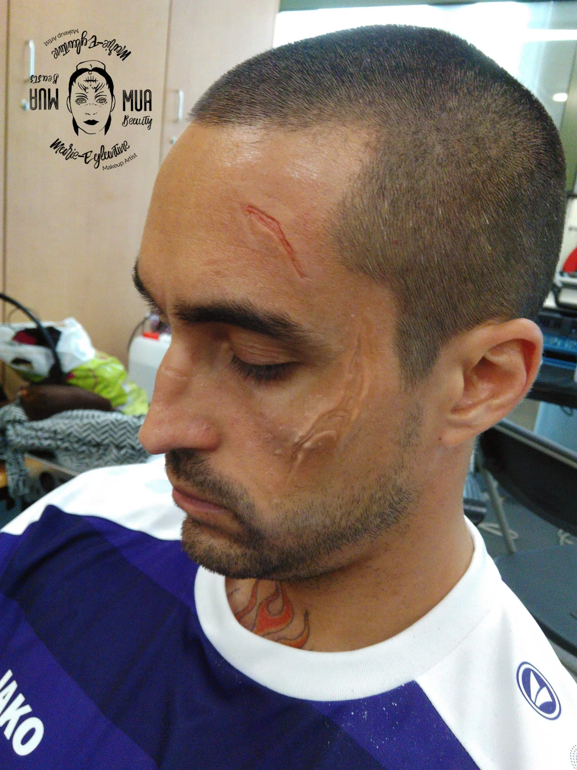 Champion RTBF Application prosthetic